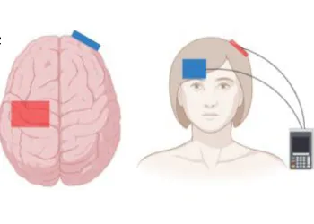 Transcranial direct current stimulation (tDCS)